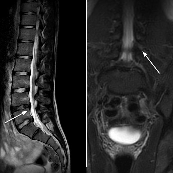 Preventive lumbar MRI