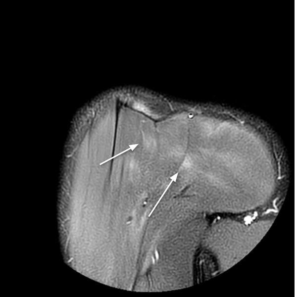 Shoulder MRI muscle edema 2