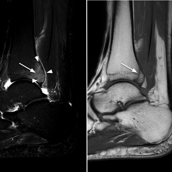 Fracture and microfractures