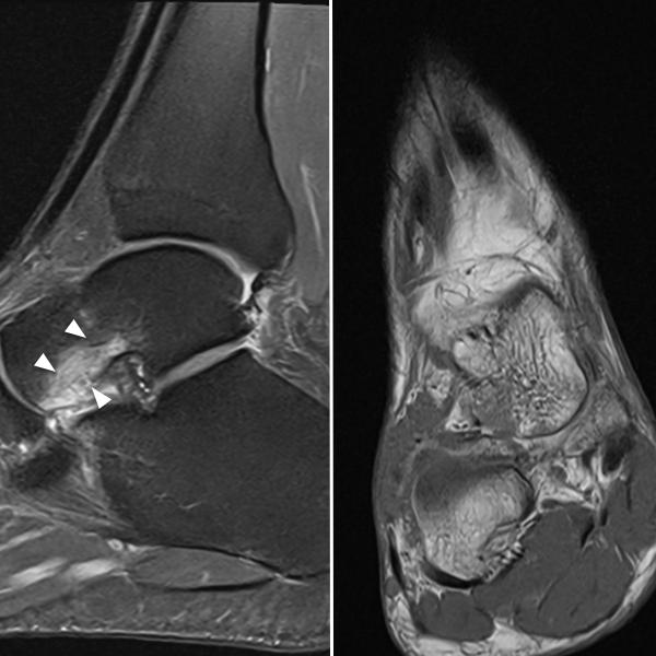 MRI impact-related microfracture