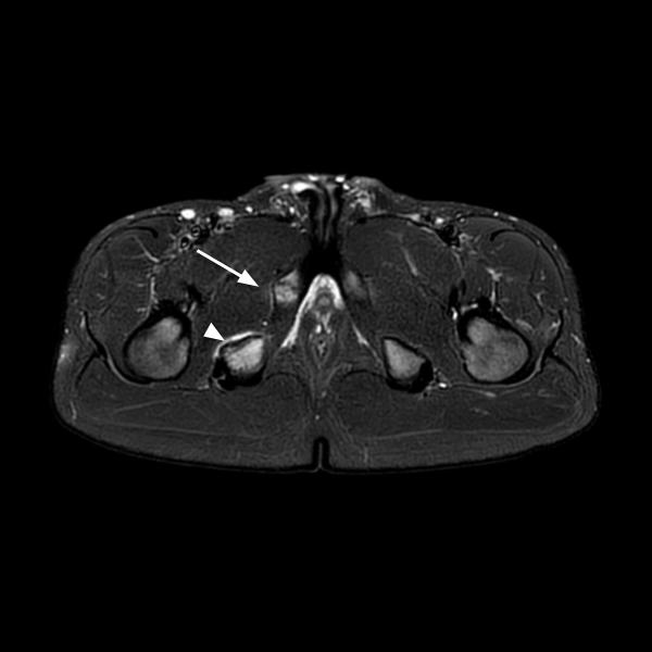 RM bacino - edema sincondrosi ischiopubica